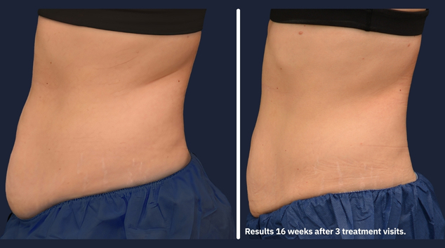 CoolSculpting Elite results after 3 visits